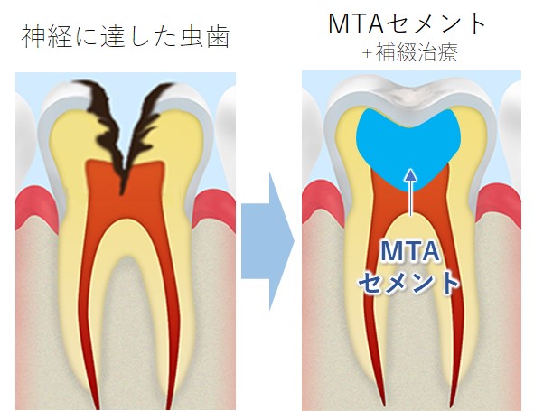 洗足池(大田区南千束)の歯医者、千葉歯科医院のMTAセメント